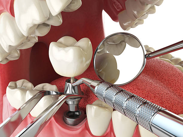 Best Emergency Wisdom Tooth Extraction in Goodhue, MN